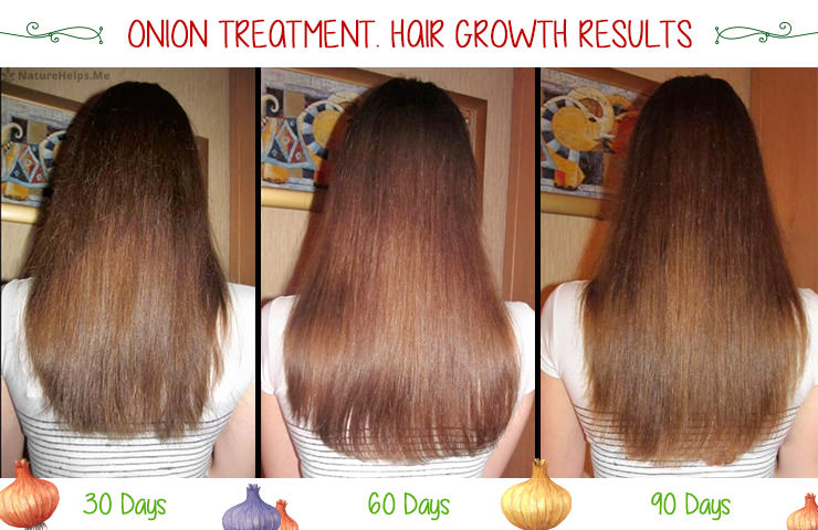 Organic Onion Hair oil for Hair Growth - 200ml - Orgoshops
